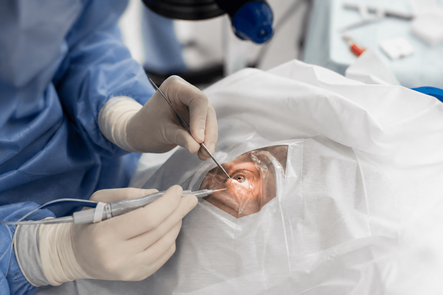 Cataract